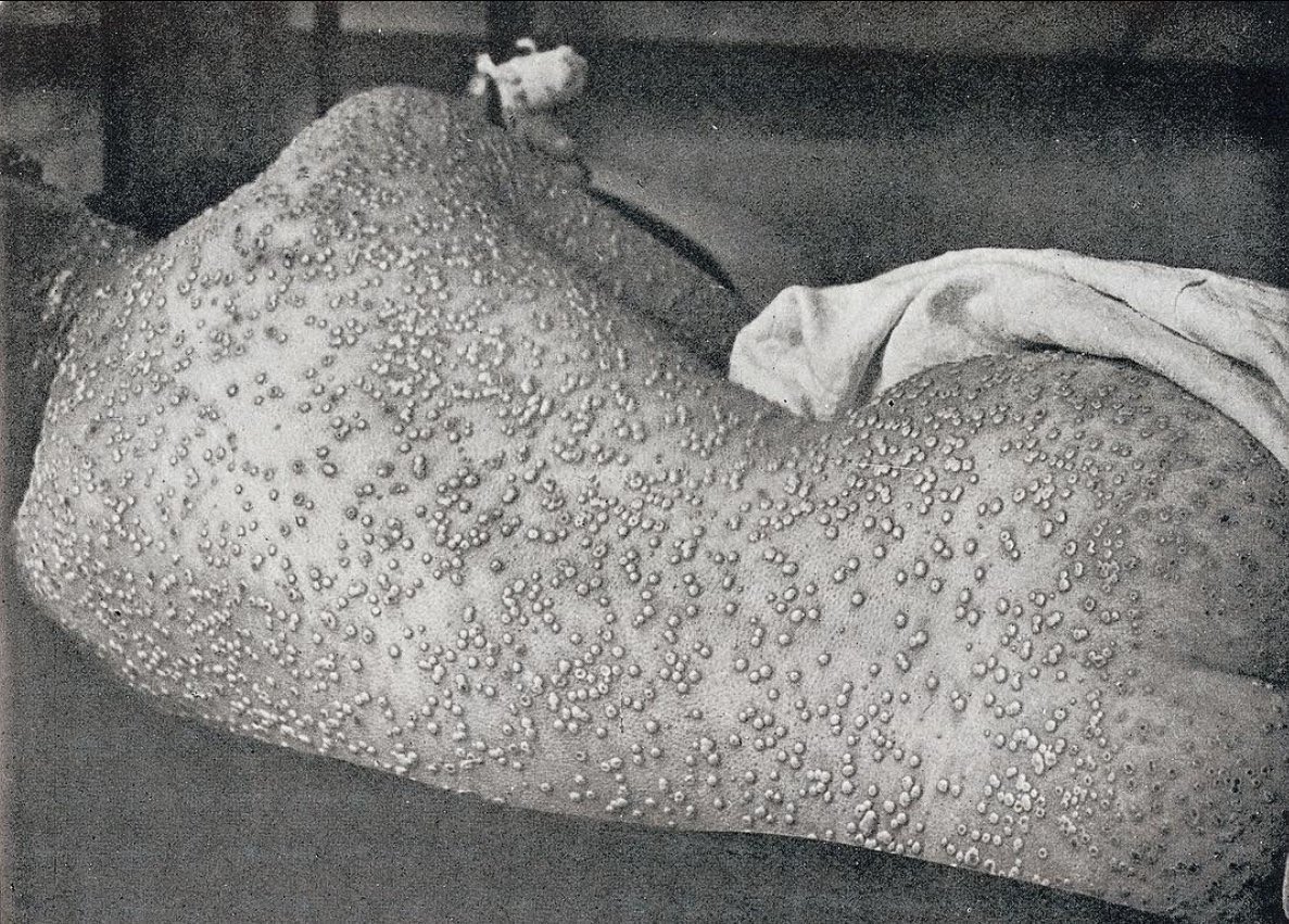 That’s nothin! 

Wait till you see MAHA’s Smallpox strategy!