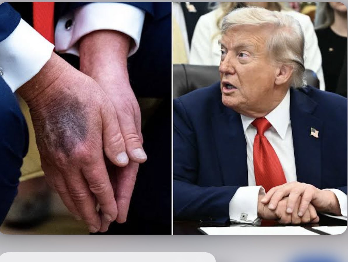 Imagine trusting a guy whose ‘bullet wound’ healed in a week, while his “handshake bruise” is still fresh after 4 months