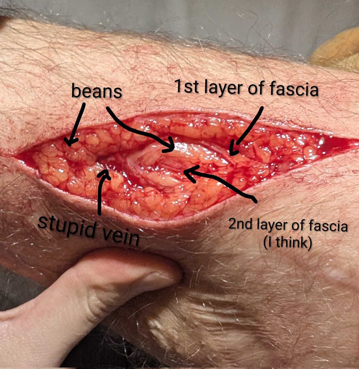 muUted_'s tweet photo. Anatomy!
I could clearly see the first fascia with this one, pretty interesting https://t.co/zvtvfCcjkr