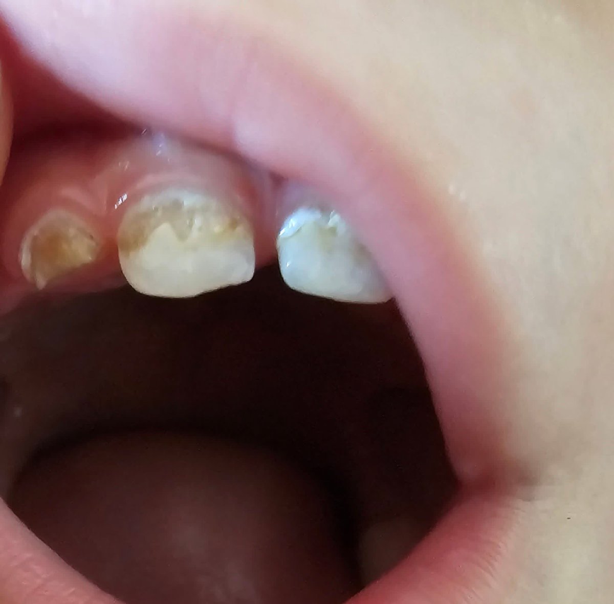 Dr_SaebGaza's tweet image. Unfortunately, I will die 😭

My little brother is losing weight rapidly due to severe dental pain. All his teeth are badly damaged, and we cannot afford his treatment. We are afraid of losing him.

If you're browsing, please leave a dot. It's just a dot.

gofund.me/e3ae5efb