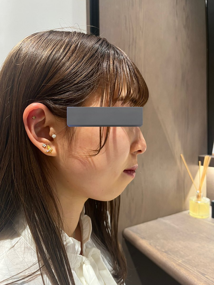 me_o089's tweet image. 両顎前の私これでした
矯正も顎ヒアルも無意味で両顎一択