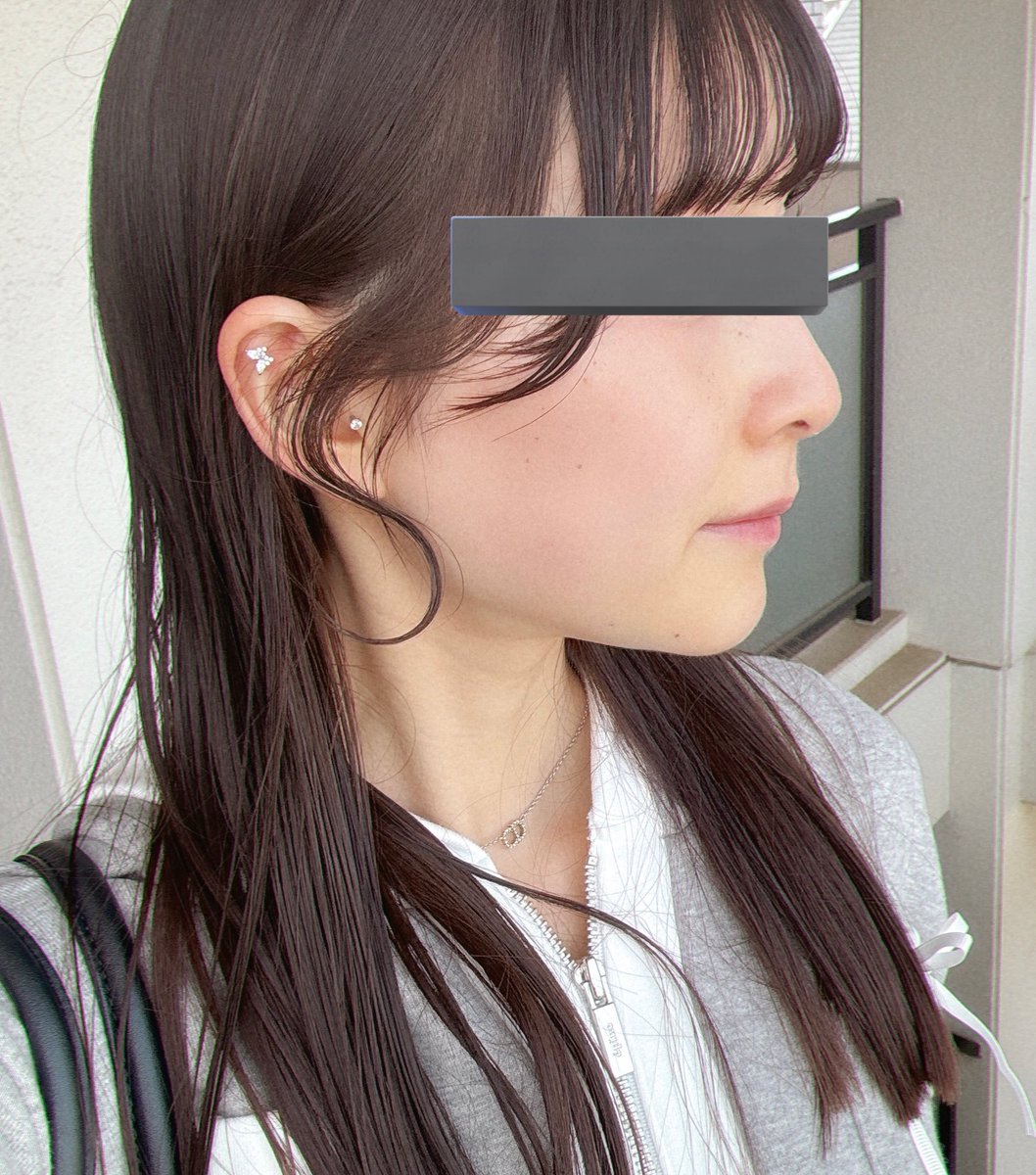 me_o089's tweet image. 両顎前の私これでした
矯正も顎ヒアルも無意味で両顎一択