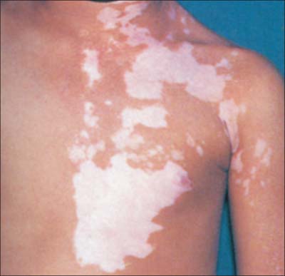 VivaHealthyLife's tweet image. Vitiligo/Leukoderma: Acupuncture and Homeopathic Treatment 

Vitiligo, aka leukoderma, is a skin disorder that causes a loss of skin color. Smooth, white areas appear on the skin. If you have vitiligo in a place...
Read more:  philahomeopathy.com/vitiligo-leuco… 
#vitiligo 
#leucoderma