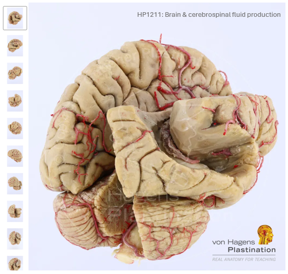 This Silicone Plastinate reveals the position and relations of the ventricular system and choroid plexus on one side and the external undissected structure of the cerebrum and cerebellum on the opposite side.
View full description and images vonhagens-plastination.com/products/silic…
#Neuroscience
