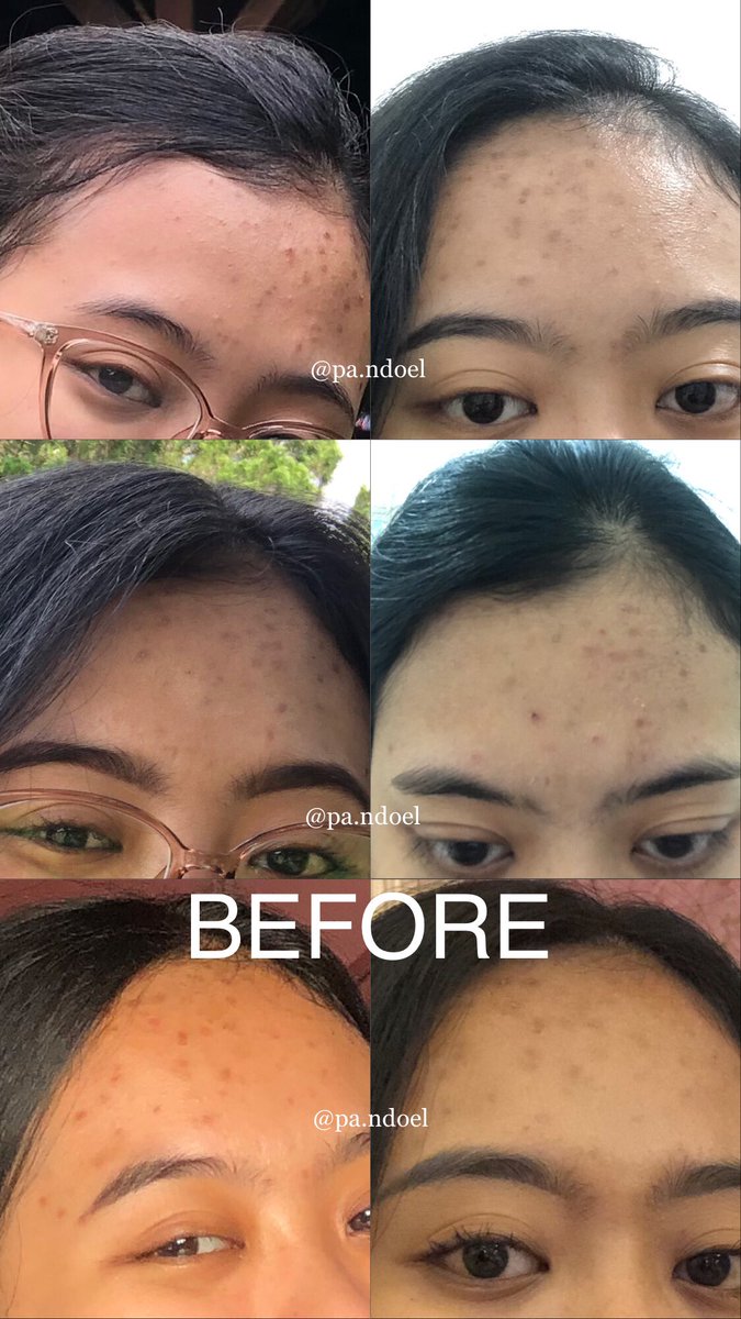cilokacin's tweet photo. @tanyarlfes toner: https://t.co/1Mk9PuyscD / https://t.co/CtoNs57KRp 
moisturizer: https://t.co/qSzZ6212cZ 
sunscreen: https://t.co/l242wrb1rt 

neem mask: https://t.co/w4PefphEhz dipakai 2x seminggu 
sheet mask bioaqua: https://t.co/mEPN4yZMe3 tiap malam https://t.co/W33wHj84v5