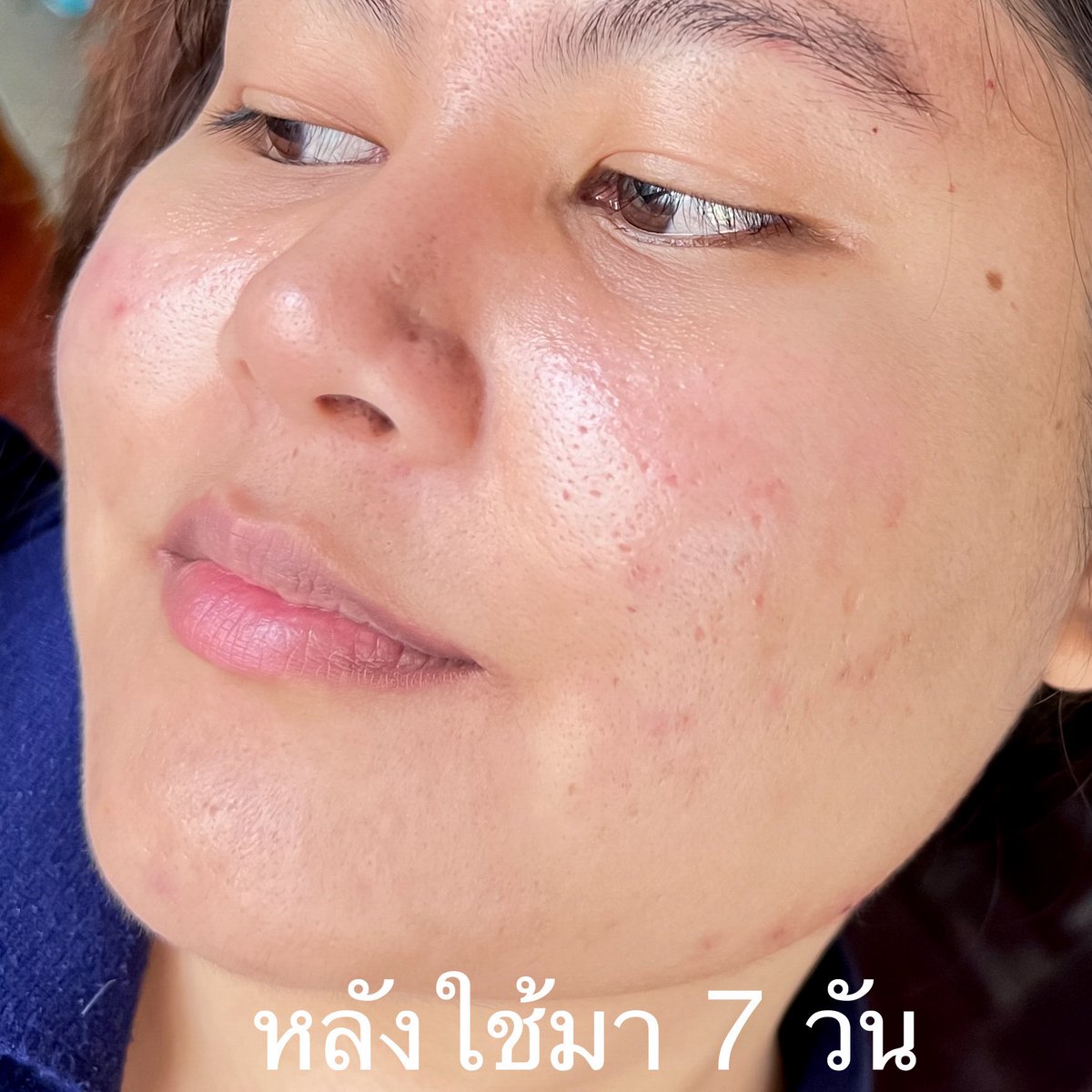 มีช่วงนึงหายไปรักษาพวกสิวและรอยดำมาได้ลองใช้มาหลายตัวมากๆ ละตัวที่ใช้ดีจนยกให้เป็นนัมเบอร์วันเลย MizuMi Advance Serum ลดรอยซองม่วงตัวนี้เลย ตัวเนื้อเซรั่มเข้มข้น ทาง่าย ซึมไว ไม่เหนอะหนะ เราใช้เช้า-เย็น แค่อาทิตย์กว่าๆพวกรอยก็เริ่มจางลงแล้ว ช่วยลดได้ทั้ง รอยดำ ฝ้า กระใดๆได้หมด