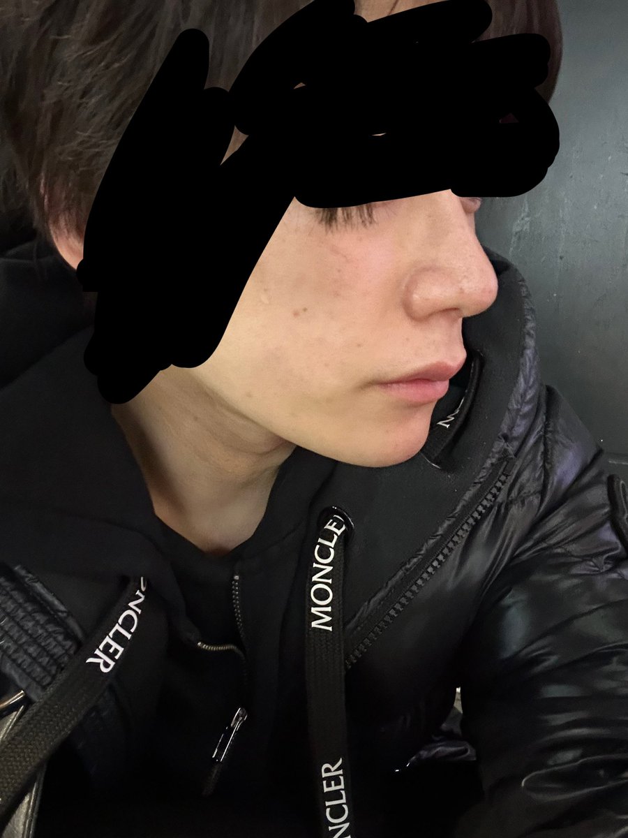 biyouseike's tweet photo. 鼻整形して
2年15日。
あの頃に比べて鼻褒められることが増えた

before→after https://t.co/NfBhzatmBl