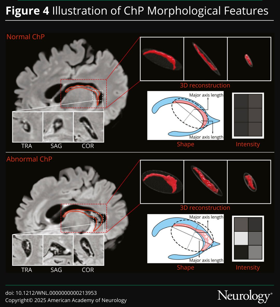 This retrospective study demonstrated that #Alzheimer disease pathologies were associated with various morphological alterations of the choroid plexus, such as hypertrophy, irregular shape, and signal nonuniformity: hubs.la/Q03Yc5R30