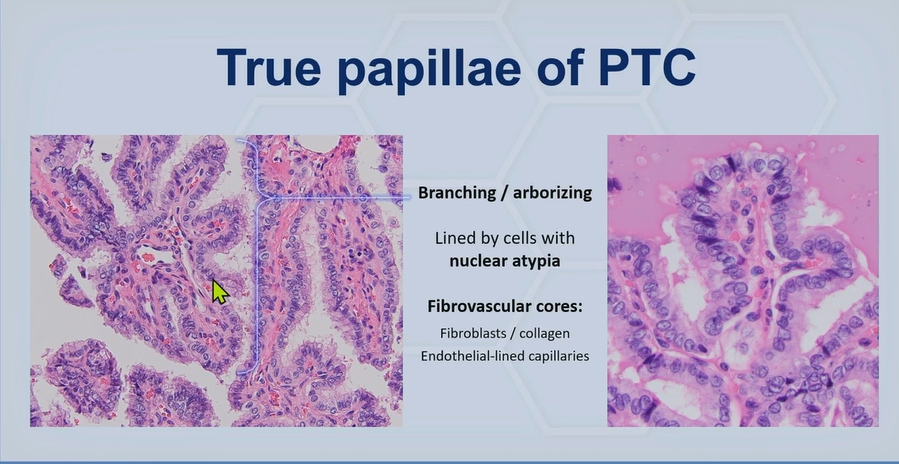 Janiranavarro's tweet photo. Noninvasive Follicular Thyroid Neoplasm with Papillary-Like Nuclear Features (NIFTP)

Allows <1% true papillae

True papillae: branching/arborizing structure lined by cells with nuclear atypia and containing fibrovascular cores (see pic 1)

Not true papillae (see pic 2):
- Transected follicle walls
- Sanderson polster

Dr. Nishino - 2025 Diagnostic Pathology Update #USCAP #pathology #PathX #PathTwitter