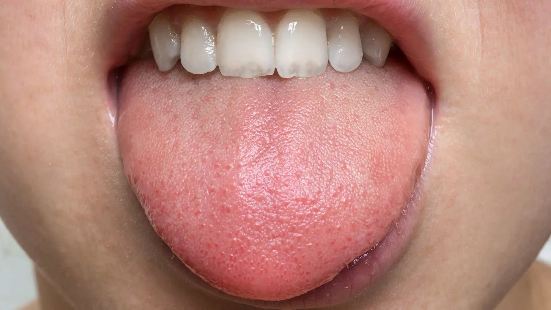 تيبس الرقبة وخدر اللسان: مرض عصبي نادر.. ماذا تعرف عن متلازمة الرقبة واللسان؟ 