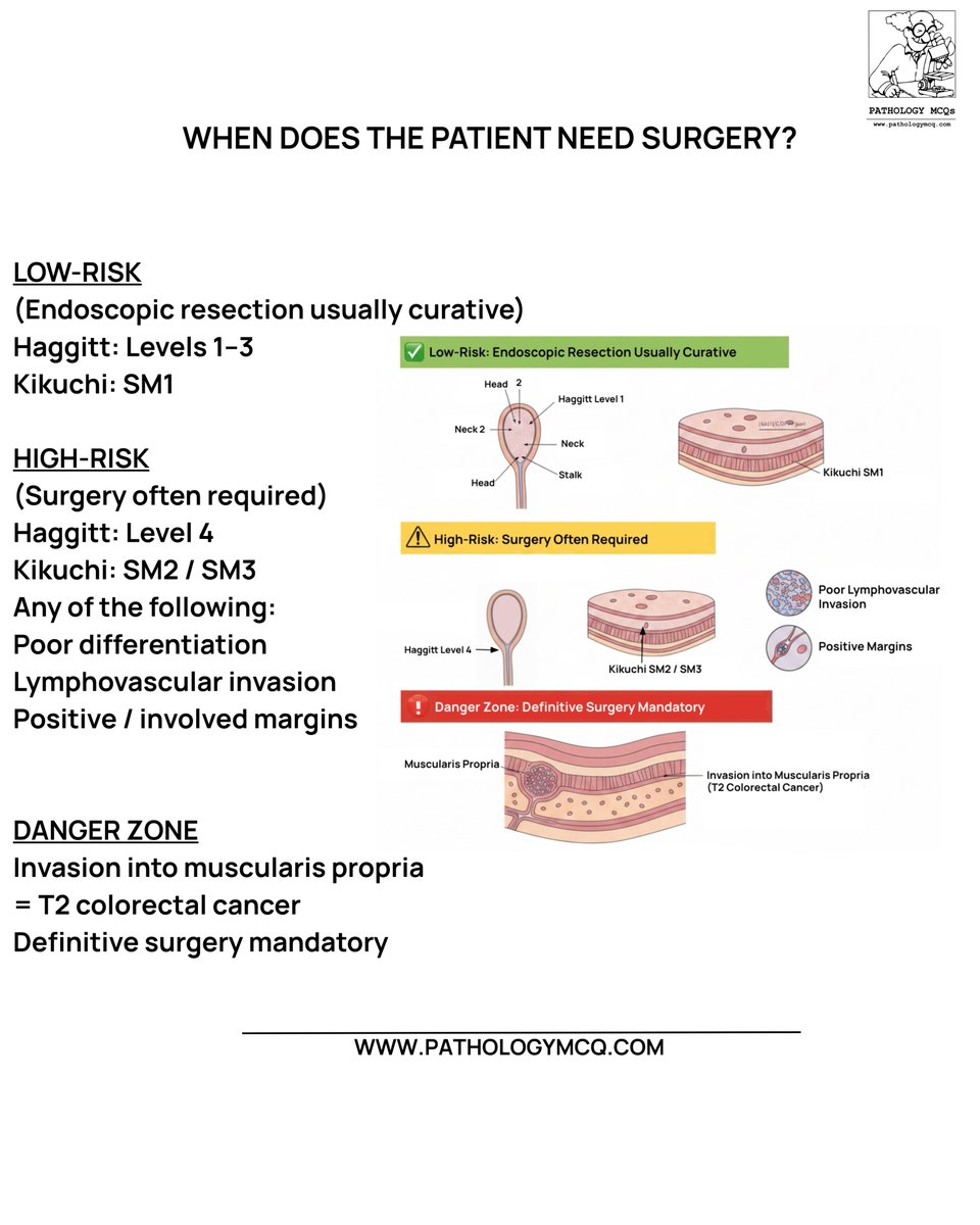 📊 Staging Cancer in Colonic Polyps 🔬

1️⃣ Polyp type: Stalked vs Sessile 🧐
2️⃣ Classification: Haggitt 🏷️ | Kikuchi 📏
Master staging &amp; predict invasion risk like a pro! 🩺✨

#ColorectalPathology #Histopathology #FRCPathPrep #PolypCancer #ExamPrep #PathologyMastery