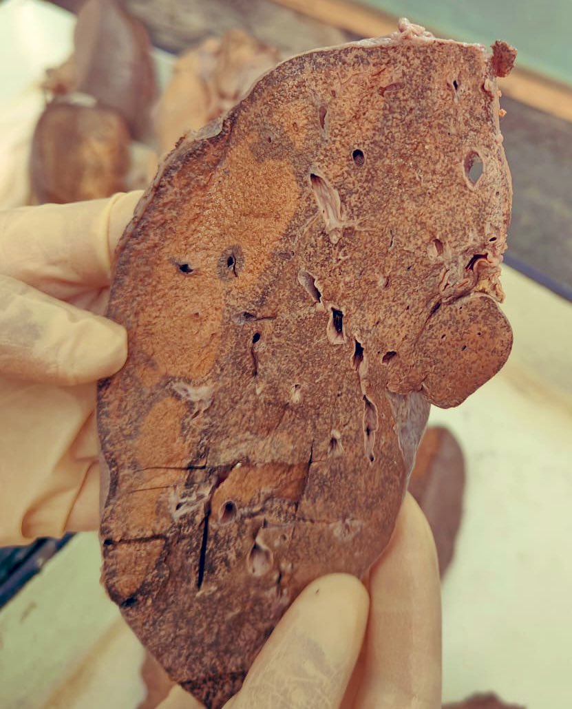 Drmona1995's tweet photo. Beautiful Nutmeg Liver Spotted 👏👏
#gross #pathx #PathTwitter #surgicalpath #residents https://t.co/mqSUY758ww
