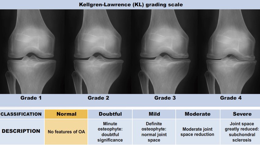 🦴📸 Kellgren–Lawrence Scale: OA at a Glance

Grading Osteoarthritis on X-ray (0–4)

Grade 0 – Normal 🦴✨
•Normal joint
•No OA changes

Grade 1 – Doubtful OA ❓🦴
•Possible tiny osteophytes
•Doubtful joint space narrowing

Grade 2 – Mild OA 🌱🦴
•Definite osteophytes