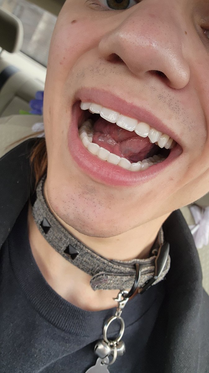 UmbraM_F's tweet photo. Fangs Before and after https://t.co/KFqRFJIZJP