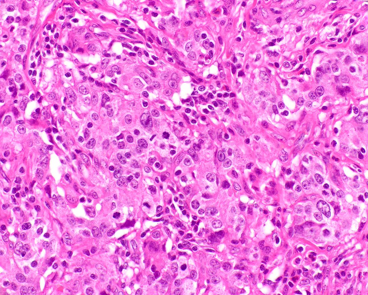 Another spectacular EBV-associated gastric carcinoma (gastric carcinoma with lymphoid stroma).  This example has overt gland formation and more sheet-like areas.
