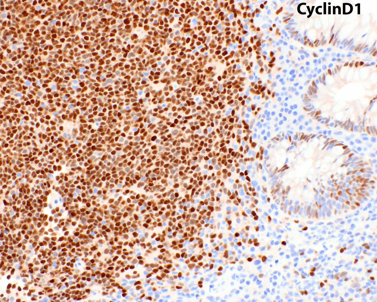 This is an ordinary mantle cell lymphoma of the colon - presenting as multiple nodular areas.  However, more aggressive subtypes are in a spectrum with large B cell lymphomas.  
Li S, Tang G, Jain P, Lin P, Xu J, Miranda RN, Cheng J, Yin CC, You MJ, Wang ML, Medeiros LJ. SOX11+