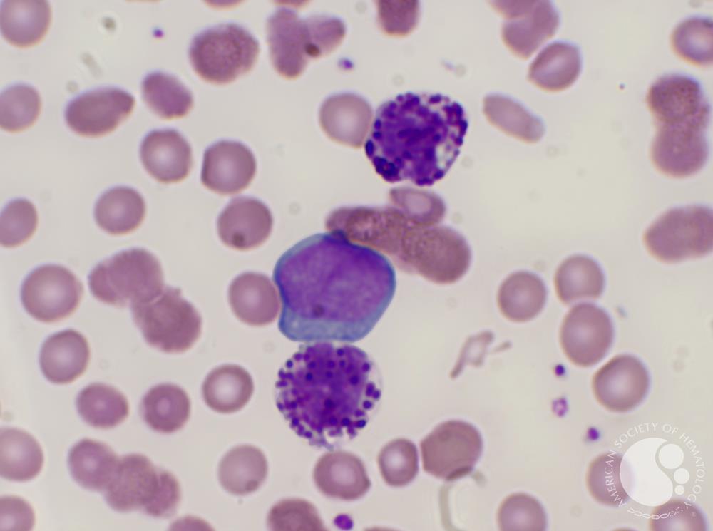 A 67 yr old ♀️ presents with fatigue and epistaxis 🩸

Pancytopenia on blood work

Myeloid blasts on blood smear 👇🏽

What's the most likely cytogenetic abnormality?