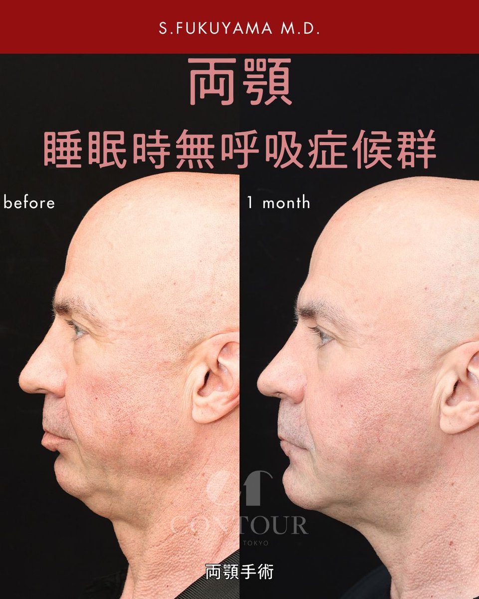 kotsukotsukiri's tweet image. 私は、睡眠時無呼吸症候群も治します。

上顎・下顎を前方移動するため、機能と審美の両立は簡単ではありません。
それでも、呼吸（機能）と顔貌（審美）の「ちょうど良いバランス」を大切にしています。