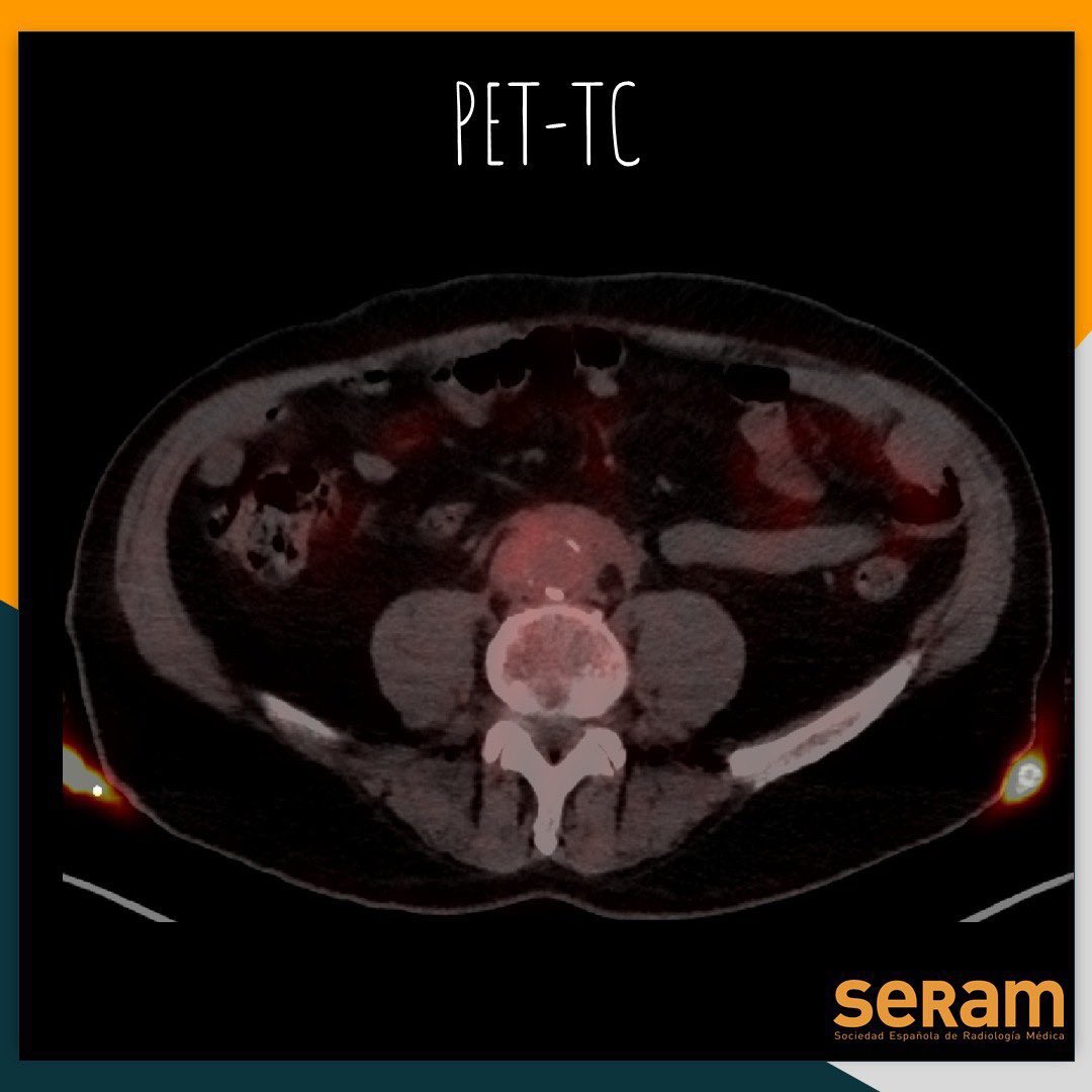 residentesSERAM's tweet photo. ¡Nuevo caso clínico! Nuestro compañera Paula Menor García (@PAULAMENOR_rx) del Complejo asistencial universitario de Salamanca🏥 nos presenta un interesante caso de Radiología Abdominal… ¿¿Sabrías contestar sin leerlo?? Esperemos que lo disfrutéis @SERAM_RX @sediabdomen https://t.co/2RZAIvIFiS