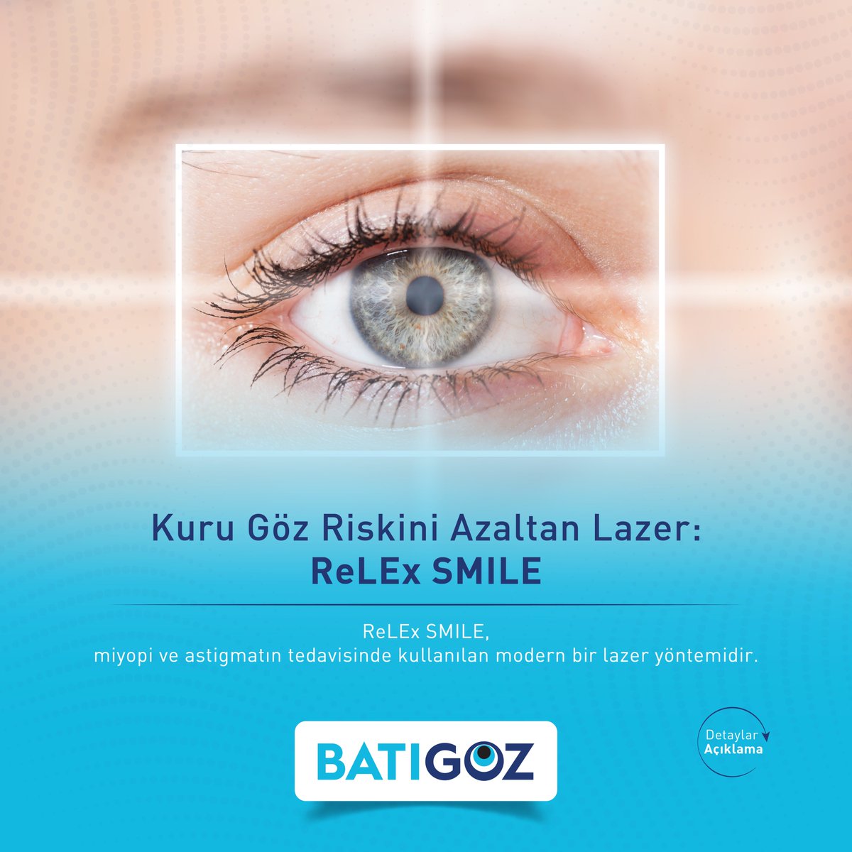 Batigoz's tweet photo. ReLEx SMILE, miyopi ve astigmatın tedavisinde kullanılan modern bir lazer yöntemidir. Bu yöntemde korneada flep (kapakçık) oluşturulmaz; yalnızca birkaç milimetrik küçük bir kesi yapılır.
❗ Sayfa içeriği bilgilendirme amaçlıdır.
#ReLExSMILE #GözSağlığı #LazerTedavisi https://t.co/1lsQsudqMc