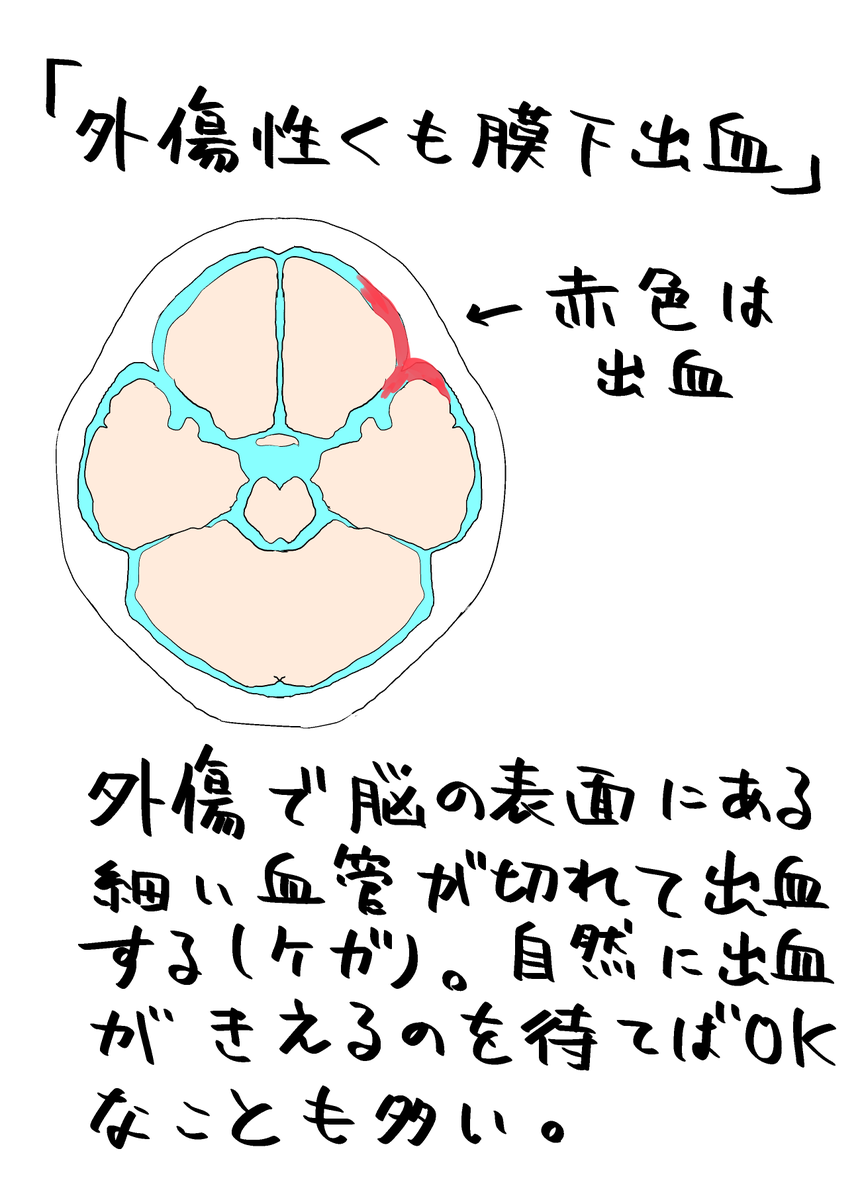 ブレイキングダウンの「くも膜下出血」という語句に振り回されてる一般の方むけに解説を書きちらしました 