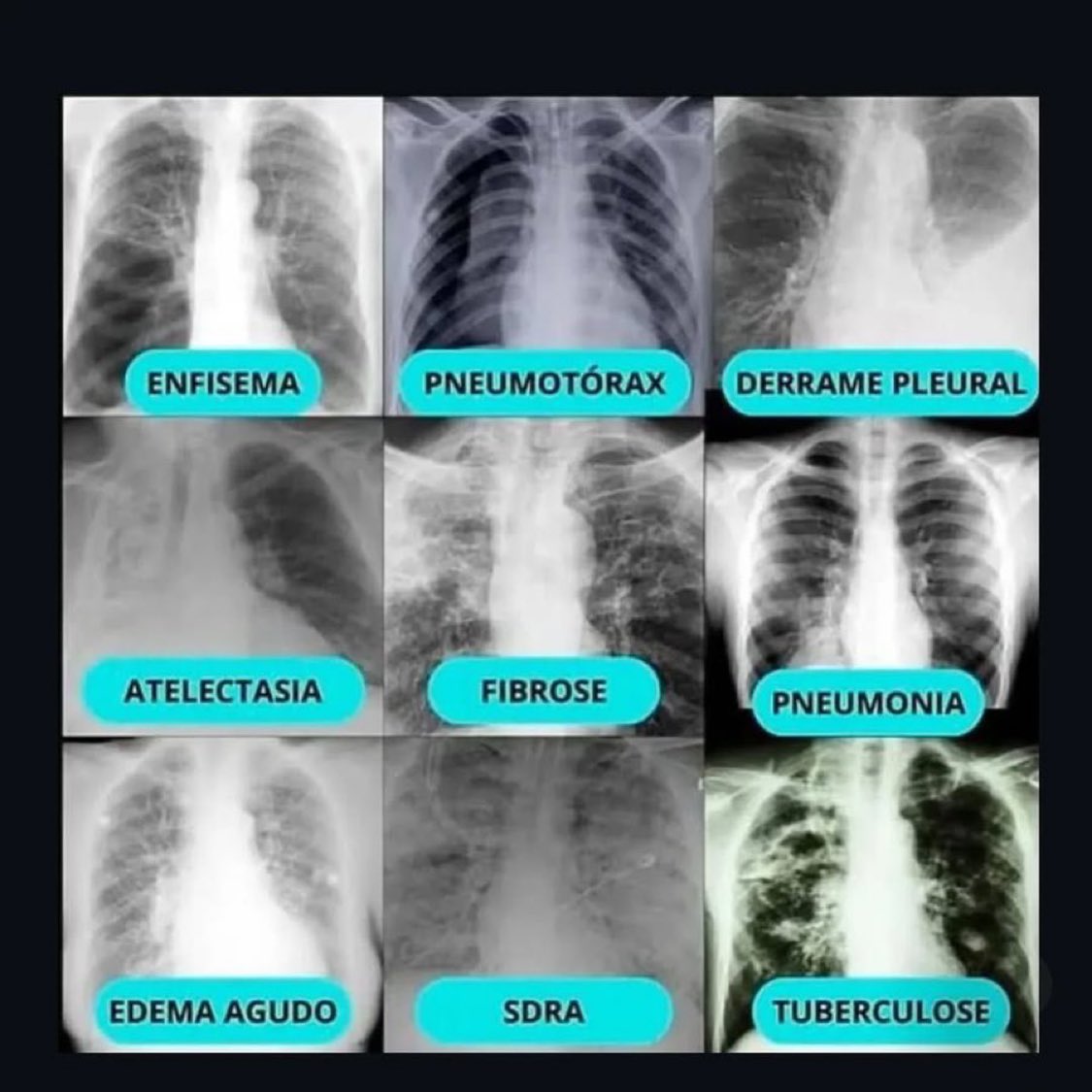 Types of chest x rays……