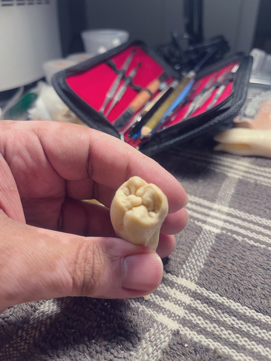 TareqBasodan's tweet photo. Wax-up work for tooth #26 (Maxillary First Molar).
Hand-crafted wax-up demonstrating precise maxillary molar anatomy, controlled cusp height, balanced cusp inclines, and functional occlusal morphology. Emphasis on accurate marginal ridges, occlusal grooves, and natural emergence profile—reflecting strong technical skills in fixed prosthodontic wax-ups.

#DentalTechnician #WaxUp #HandWaxUp #DentalLab
#FixedProsthodontics #MaxillaryMolar #DentalAnatomy
#DentalCeramics #CADCAM #Exocad #DentalCareer