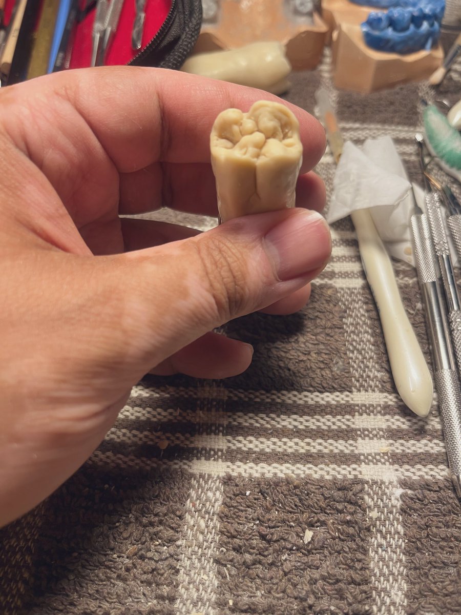 TareqBasodan's tweet photo. Wax-up work for tooth #26 (Maxillary First Molar).
Hand-crafted wax-up demonstrating precise maxillary molar anatomy, controlled cusp height, balanced cusp inclines, and functional occlusal morphology. Emphasis on accurate marginal ridges, occlusal grooves, and natural emergence profile—reflecting strong technical skills in fixed prosthodontic wax-ups.

#DentalTechnician #WaxUp #HandWaxUp #DentalLab
#FixedProsthodontics #MaxillaryMolar #DentalAnatomy
#DentalCeramics #CADCAM #Exocad #DentalCareer