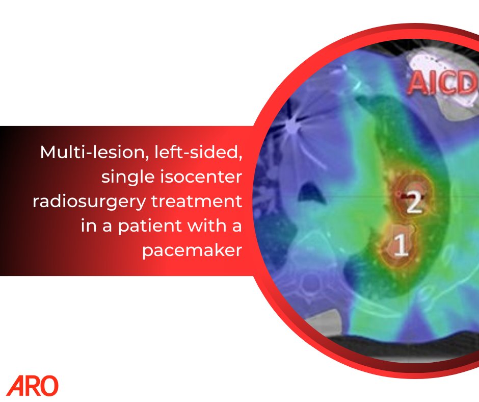 Applied_RadOnc's tweet image. ✨ In case you missed it - Top 25 from '25

Multi-lesion, left-sided, single isocenter radiosurgery treatment in a patient with a pacemaker

🔗 zurl.co/UhkC5 

#radonc #radonced #radiationoncology #icymi
