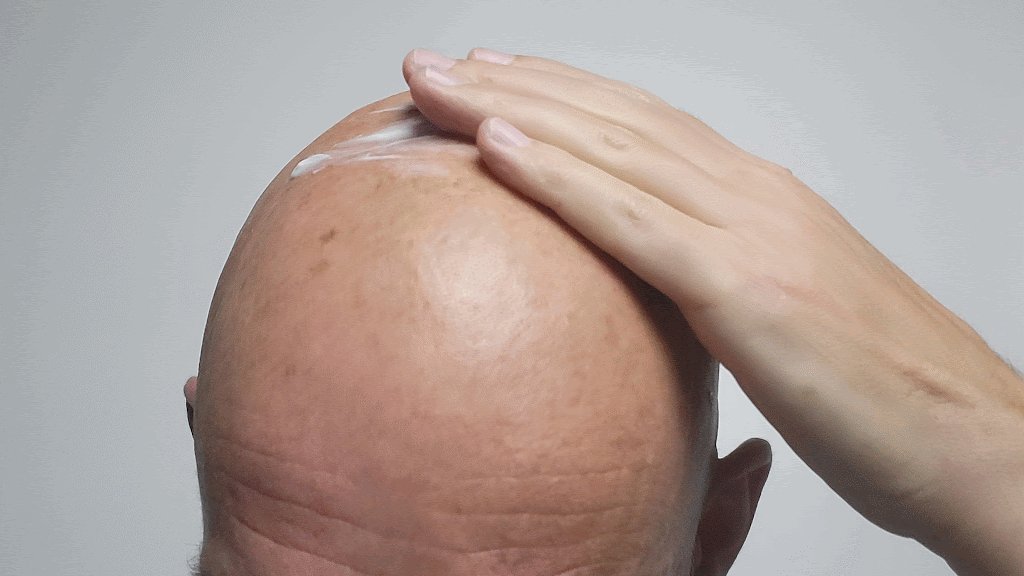 يُعيد إنبات الشعر سريعًا وبدون مضاعفات.. دواء يُعالج جميع أنواع الصلع في 3 أسابيع 