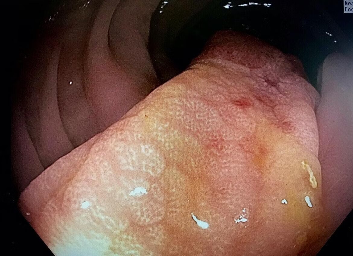 EndoCollab™ | GI Endoscopy Community tweet media