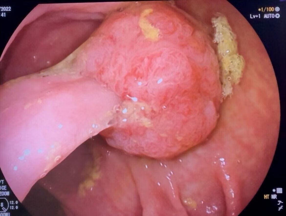 EndoCollab™ | GI Endoscopy Community tweet media