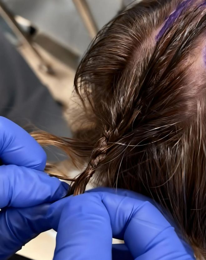 PeterNakajiMD's tweet image. “If you can do microsurgery, you can learn to braid hair.”

For years we shaved heads before brain surgery. Looked closer: leaving hair doesn’t raise risk of complications and patients prefer it.

So I braid it. More work, more dignity. They’ll see that in the mirror every day.