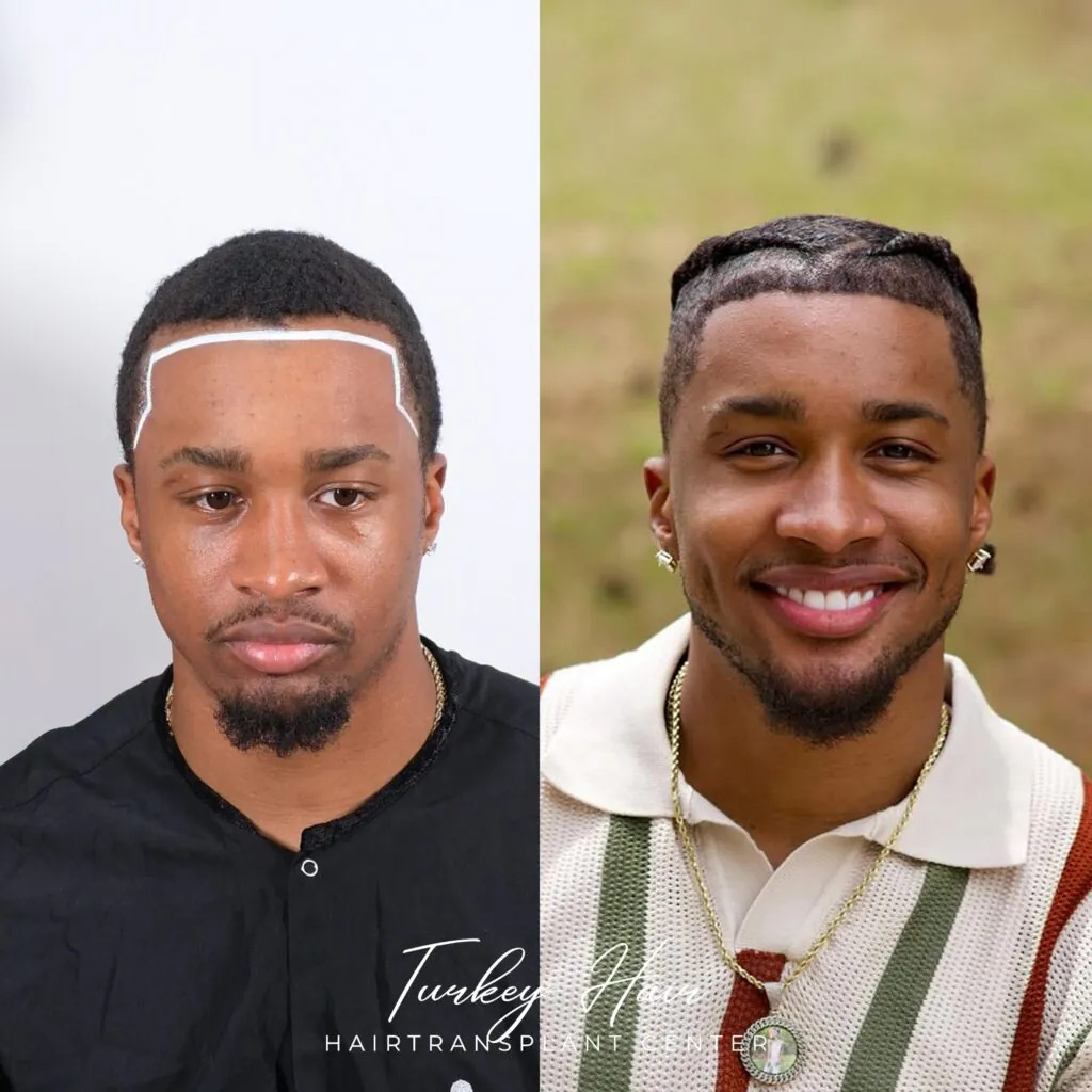 TurkeyHairCentr's tweet photo. Hair loss is a common concern worldwide, but for individuals with Afro-textured hair, the solution requires far more than standard techniques. Afro hair transplant must be performed by clinics that truly understand 3C–4C hair anatomy.

https://t.co/cummkAVzA2 https://t.co/5x1Q7CaWEe