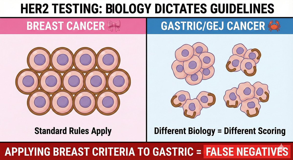 (1/5) HER2 testing is NOT "one size fits all." 🧬
If you apply Breast Cancer scoring rules to Gastric Cancer, you are creating a recipe for false negatives.

Biology dictates the guidelines.

Here are the 3 Critical Differences between HER2 in Breast vs. Gastric/GEJ. 🧵👇