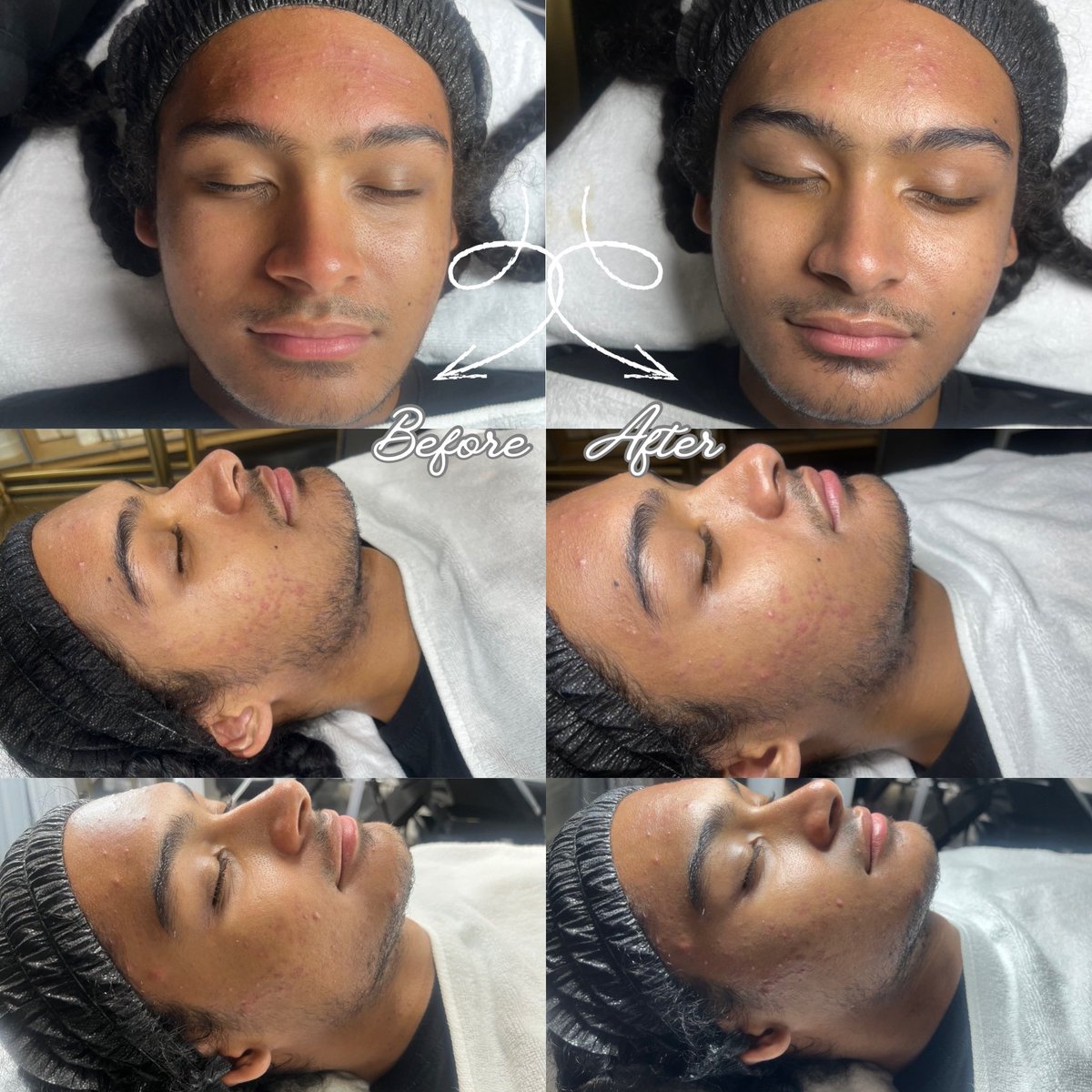 🫧 The Verdict Facial 🫧

We just wrapped this client’s case file focused on acne concerns. The evidence presented: professional extractions to clear congestion, deep pore purification, and clarifying ingredients to balance troubled skin.