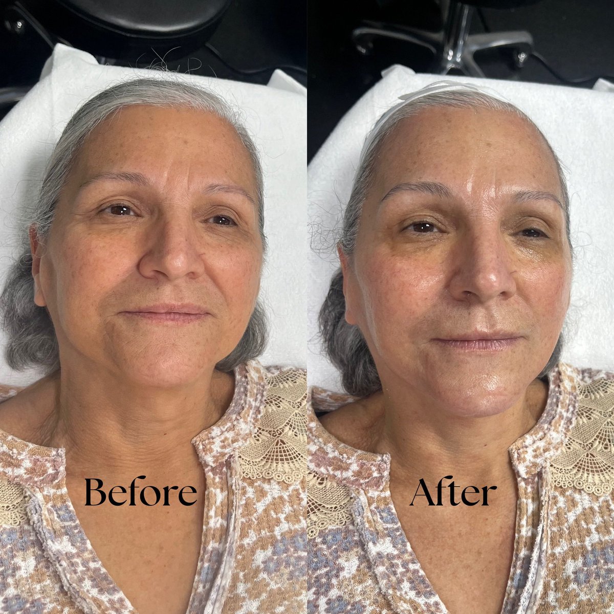 The Statute of Limitations Facial ⚖️

When it comes to aging… we’re filing an appeal.✨
Erase the evidence of fine lines, wrinkles, and dullness with this advanced anti-aging treatment that keeps your youth and glow on the record.

This service now includes a Retinol Peel