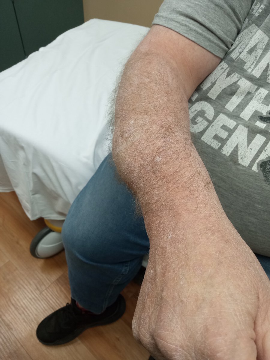 BrooksideRaider's tweet image. The hazards of taking a trash can down in the dark. Stumbled over a large rock &amp;amp; slammed into a mailbox on a wooden platform. Turns out it is a massive hematoma, but nothing broken. Give me a week &amp;amp; I'll be back at it again. But no more taking the trash down in the dark again.