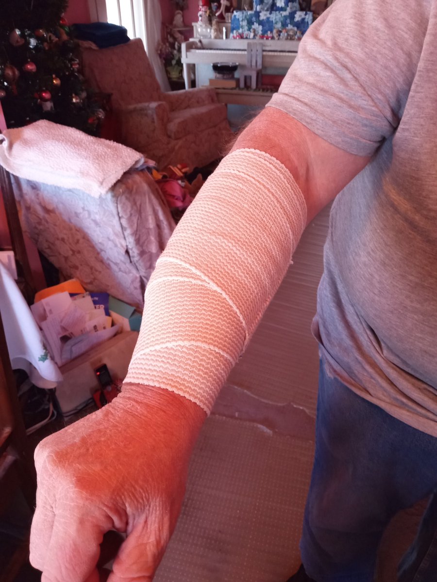 BrooksideRaider's tweet image. The hazards of taking a trash can down in the dark. Stumbled over a large rock &amp;amp; slammed into a mailbox on a wooden platform. Turns out it is a massive hematoma, but nothing broken. Give me a week &amp;amp; I'll be back at it again. But no more taking the trash down in the dark again.