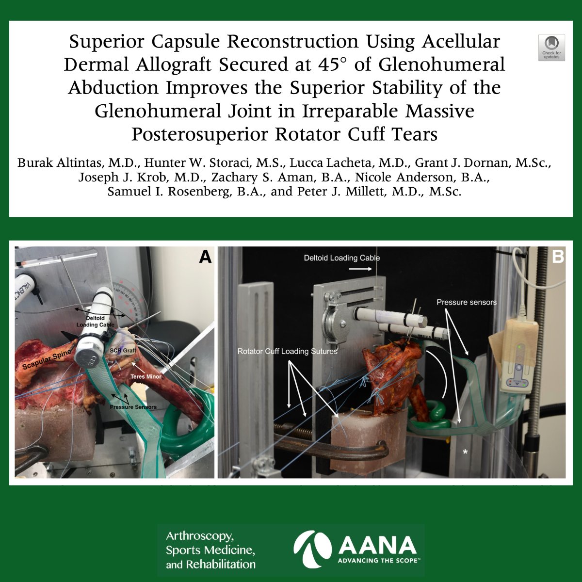 ArthroscopyJ's tweet photo. SCR fixation at 45 degrees of glenohumeral abduction provided more stability than did fixation at 30 degrees #RotatorCuffTear @BurakAltintasMD @millettmd https://t.co/I4pDTyLpe0