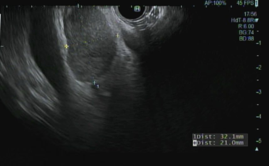 EUSandEndoscopy's tweet image. CT &amp;gt;3 cm “pedunculated” mass arising from liver or adjacent. #EUS from bulb reveals well demarcated homogeneous hypoechoic mass superficial to portal vein not involved CBD. #FNB moderately differentiated Hepatocellular carcinoma #HCC with pseudoacinar features CK7 &amp;amp; HepPar+