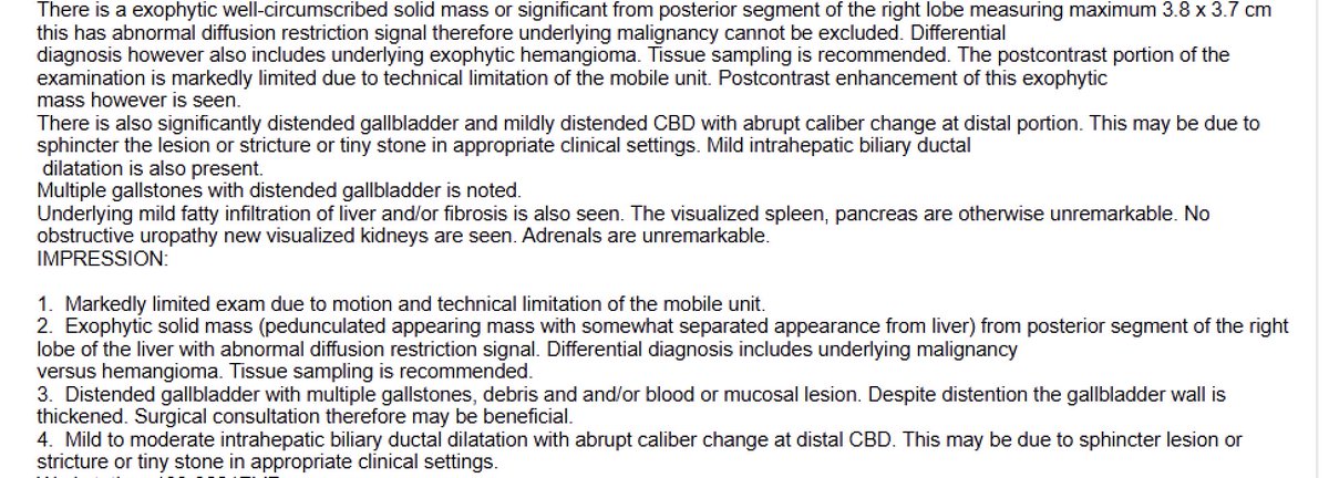 EUSandEndoscopy's tweet image. CT &amp;gt;3 cm “pedunculated” mass arising from liver or adjacent. #EUS from bulb reveals well demarcated homogeneous hypoechoic mass superficial to portal vein not involved CBD. #FNB moderately differentiated Hepatocellular carcinoma #HCC with pseudoacinar features CK7 &amp;amp; HepPar+