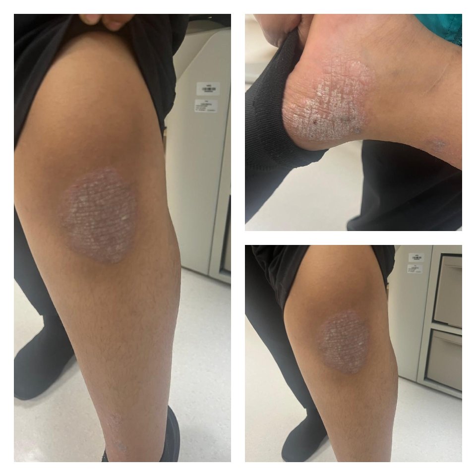 what is the diagnosis?<a href="/IhabFathiSulima/">Dr Ihab Suliman</a> #MEDHTM <a href="/hemo_shk/">Dr.Haitham Hamoud | د.هيثم</a> @Jkbjb1 #TooCloseToDiagnose <a href="/MoarSahitoPTI/">Dr. Muhammad Moor</a>
<a href="/MRCEMPREP/">Daily Dose of Medicine</a>
<a href="/neoskinhealer/">Dr. ISHWAR N RATHORE MD</a> <a href="/DrBassemKurdi/">د. باسم | طبيب أطفال</a>
<a href="/mohammadalmogbi/">الدكتور محمد المقبل</a>