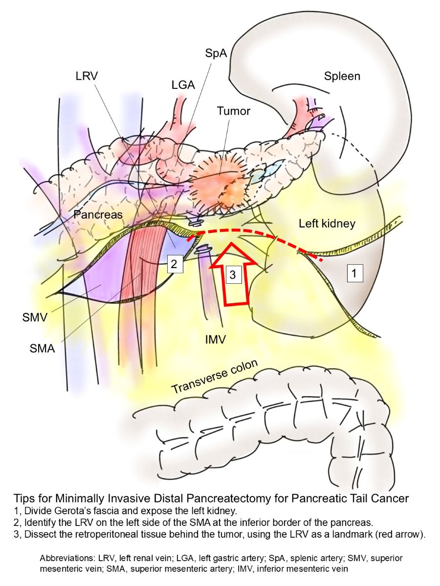jses_eng's tweet image. JSES IllustCon 53
📌To achieve a negative surgical margin at the retroperitoneal side in pancreatic tail cancer
📝In minimally invasive distal pancreatectomy for pancreatic tail cancer, this figure illustrates tips for retroperitoneal dissection to secure the posterior surgical…