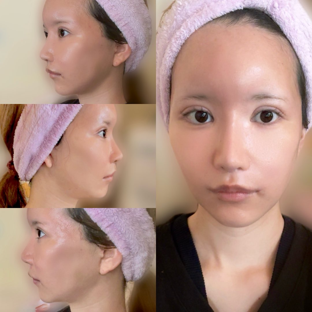 うる@切開リフトDT tweet media