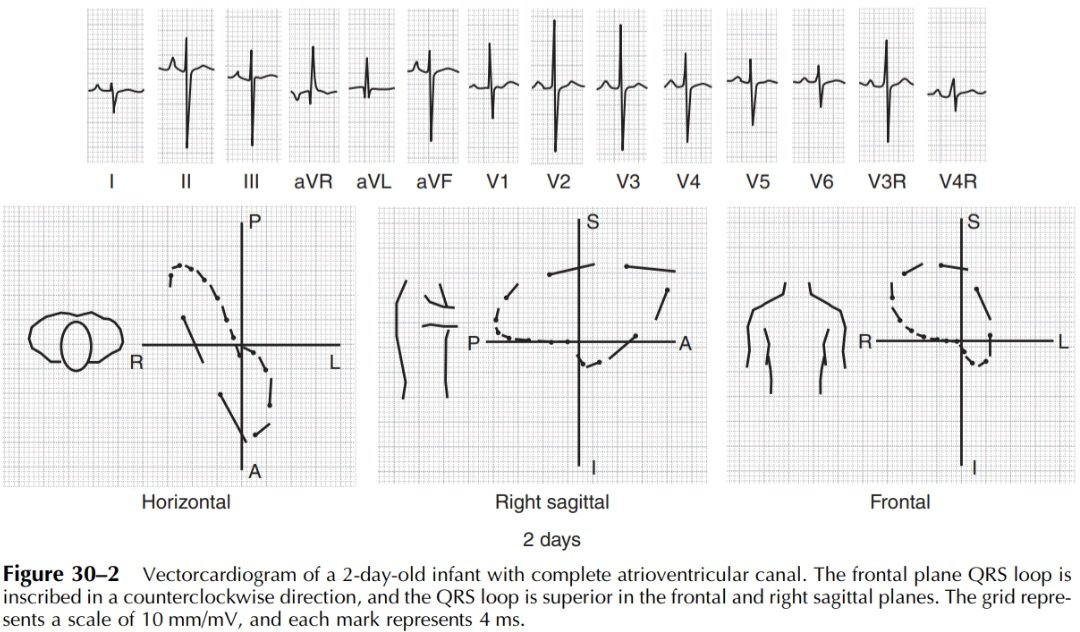 EKG: Comunicación InterAuricular. 🫀⚡️
🔶️El niño con CIA tipo secundum puede tener ondas P en pico en DII, sugiriendo crecimiento de AD.
🔶️El intervalo PR y el intervalo HV en niños con CIA tipo secundum, han demostrado ser significativamente más largos.
🔶️Cuando el shunt