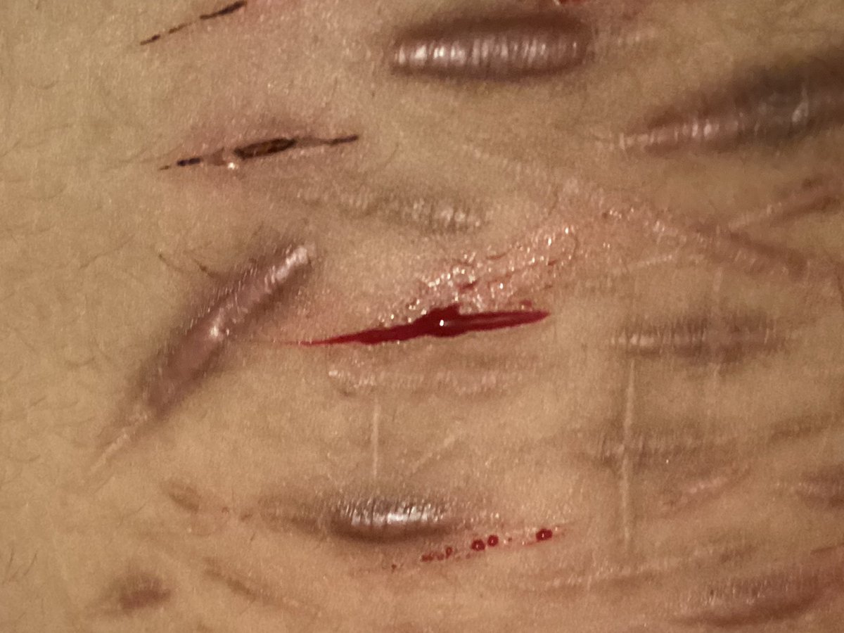prettypurpjr's tweet photo. #shtwt #shedtwt #littwt #ouchietwt #988twt #slittwt #styros #cutting #cuts more cutss https://t.co/EcGR9jajSR