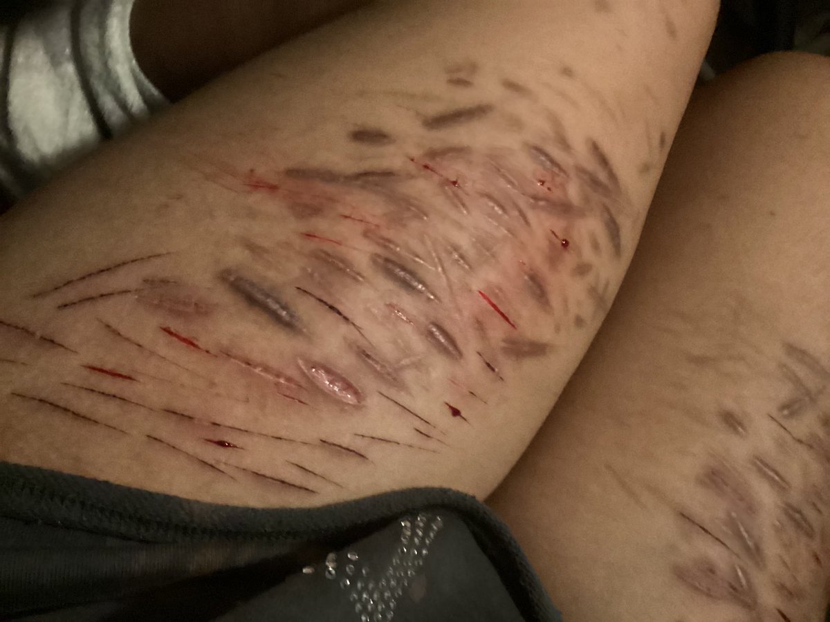 prettypurpjr's tweet photo. #shtwt #shedtwt #littwt #ouchietwt #988twt #slittwt #styros #cutting #cuts dont forget my strwpage exists https://t.co/6YGkcs7FiT