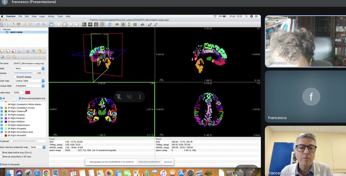 StrokeFocus's tweet photo. A freesurfer whole brain ���🧠👀 phantom analysis; to address performance of an AI vs other software. 🫥🧠👀 https://t.co/zzaL7y0NIm