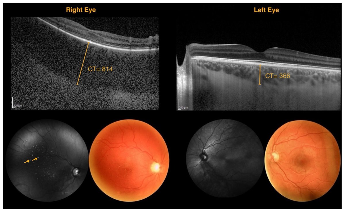 JCM_MDPI's tweet photo. #mdpijcm
#LatestPaper sharing✨
Advancing Non-Invasive #OphthalmicImaging in #SturgeWeberSyndrome: Clinical Guidelines Towards Early Choroidal Hemangioma Detection
🔗https://t.co/9Itq7qyKcs
🏬@SapienzaRoma
@MediPharma_MDPI 
#retinalimaging https://t.co/KFh8cSMoIv